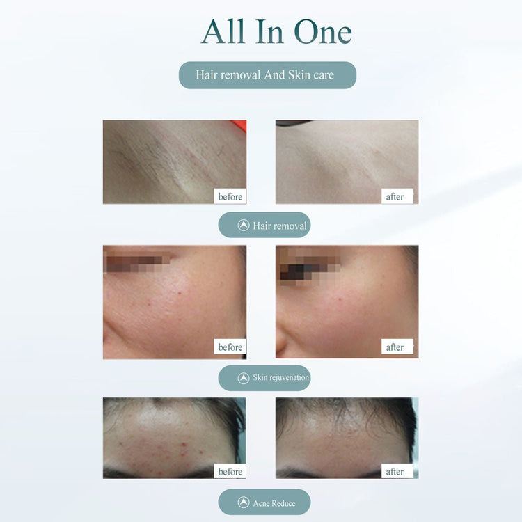 Laser Hair Removal Device - Painless Hair Removal Tool - Y Files